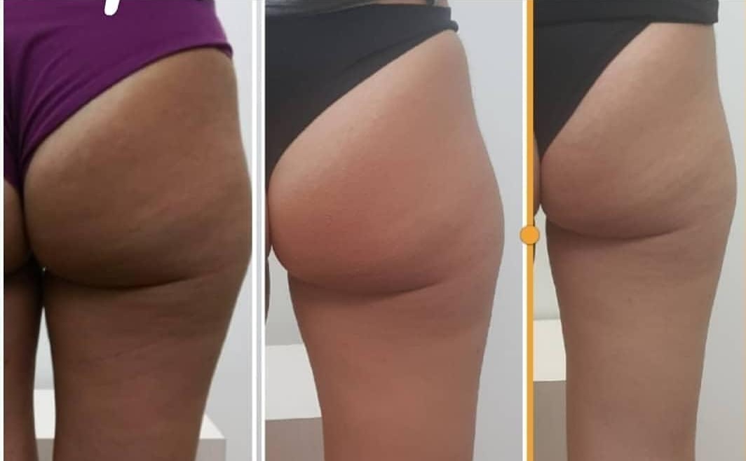 Be Body Laser — Centro Estetico Turan Aradeo, foto 1