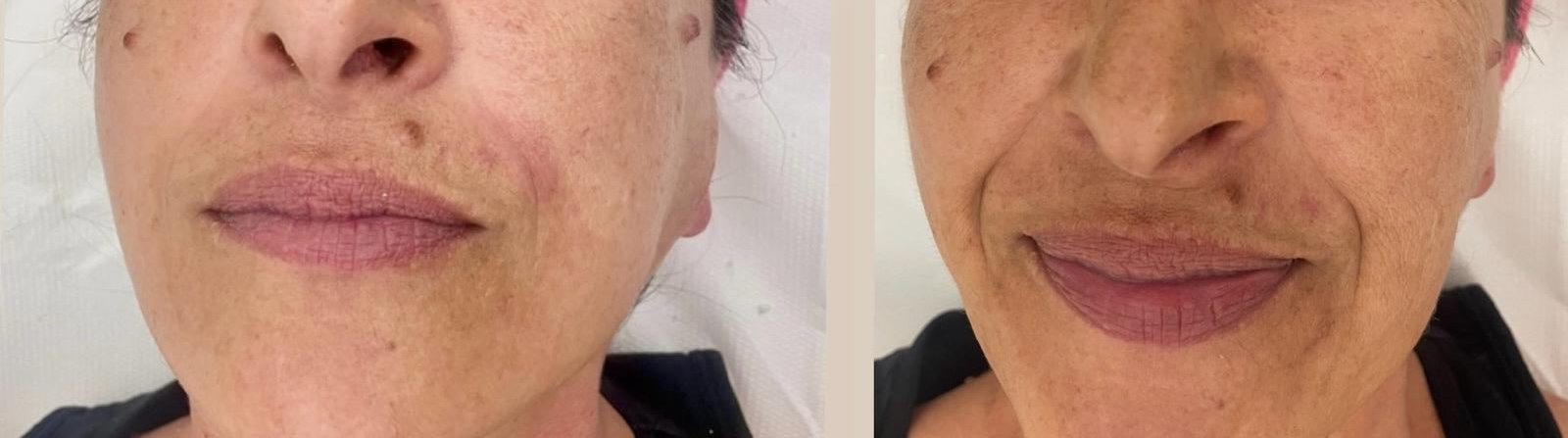Microneedling con Esosomi — Centro Estetico Turan Aradeo, foto 1
