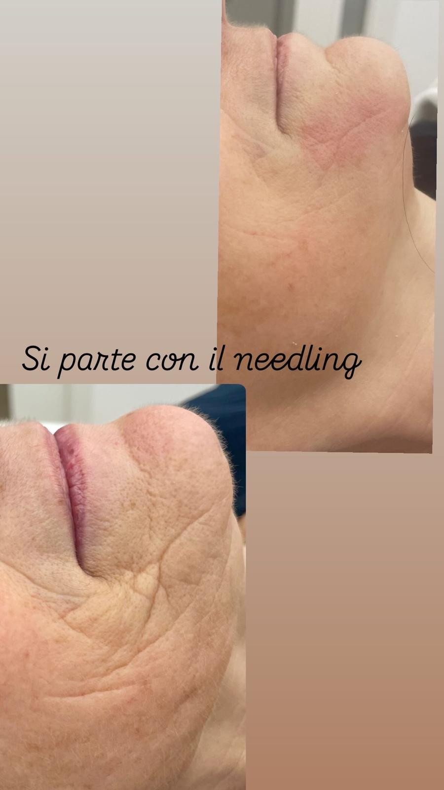 Microneedling con Esosomi — Centro Estetico Turan Aradeo, foto 2